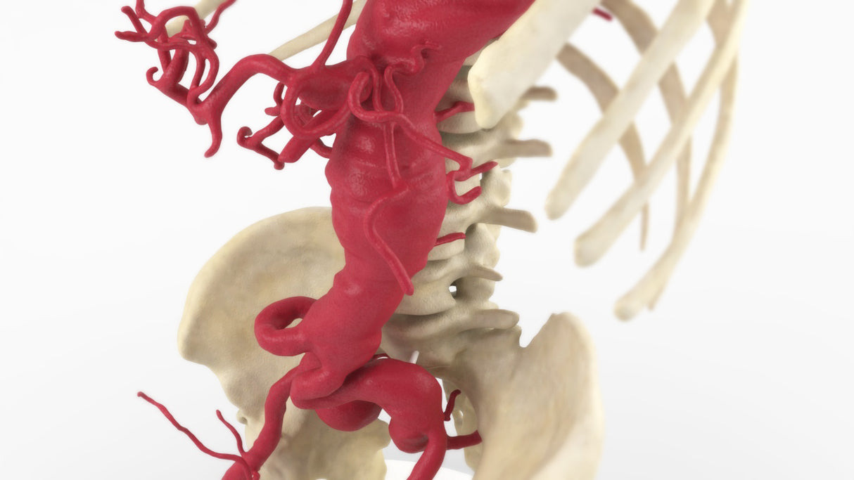 Thoracoabdominal and Bilateral Iliac Artery Aneurysm (IAA)