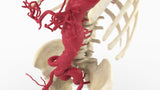 Thoracoabdominal and Bilateral Iliac Artery Aneurysm (IAA)