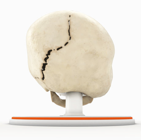 Infant Skull With Unilateral Craniosynostosis of the Lambdoid Suture - Female, 7 Months