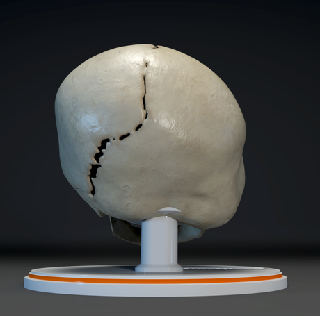 Infant Skull With Unilateral Craniosynostosis of the Lambdoid Suture - Female, 7 Months