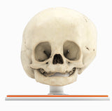 Infant Skull With Unilateral Craniosynostosis of the Lambdoid Suture - Female, 7 Months