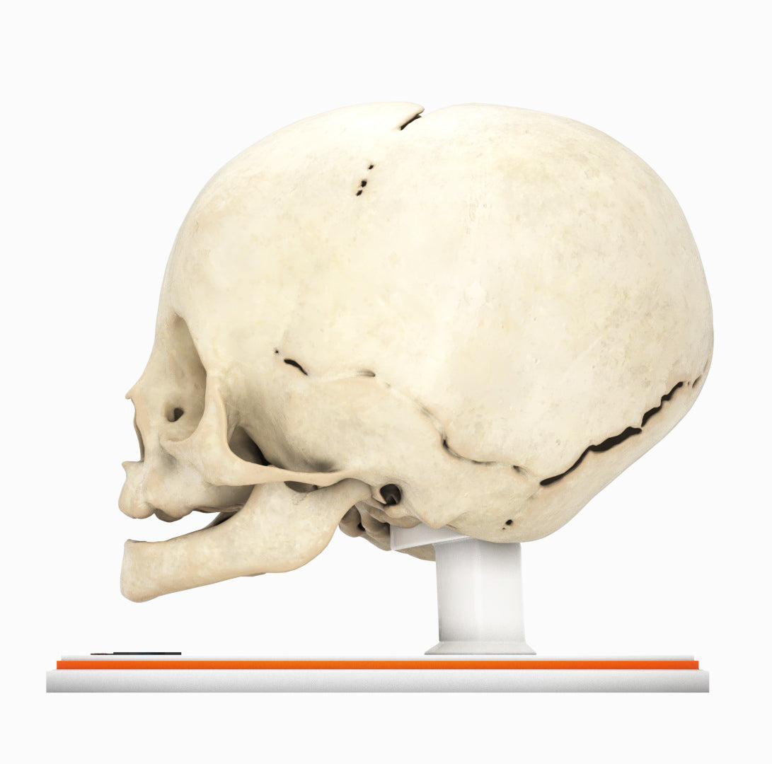 Infant Skull With Unilateral Craniosynostosis of the Lambdoid Suture - Female, 7 Months