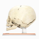 Infant Skull With Unilateral Craniosynostosis of the Lambdoid Suture - Female, 7 Months