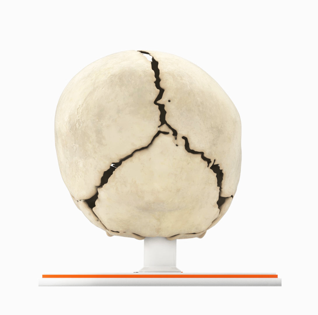 Infant Skull With Unilateral Craniosynostosis of the Coronal Suture - Male, 4 Months