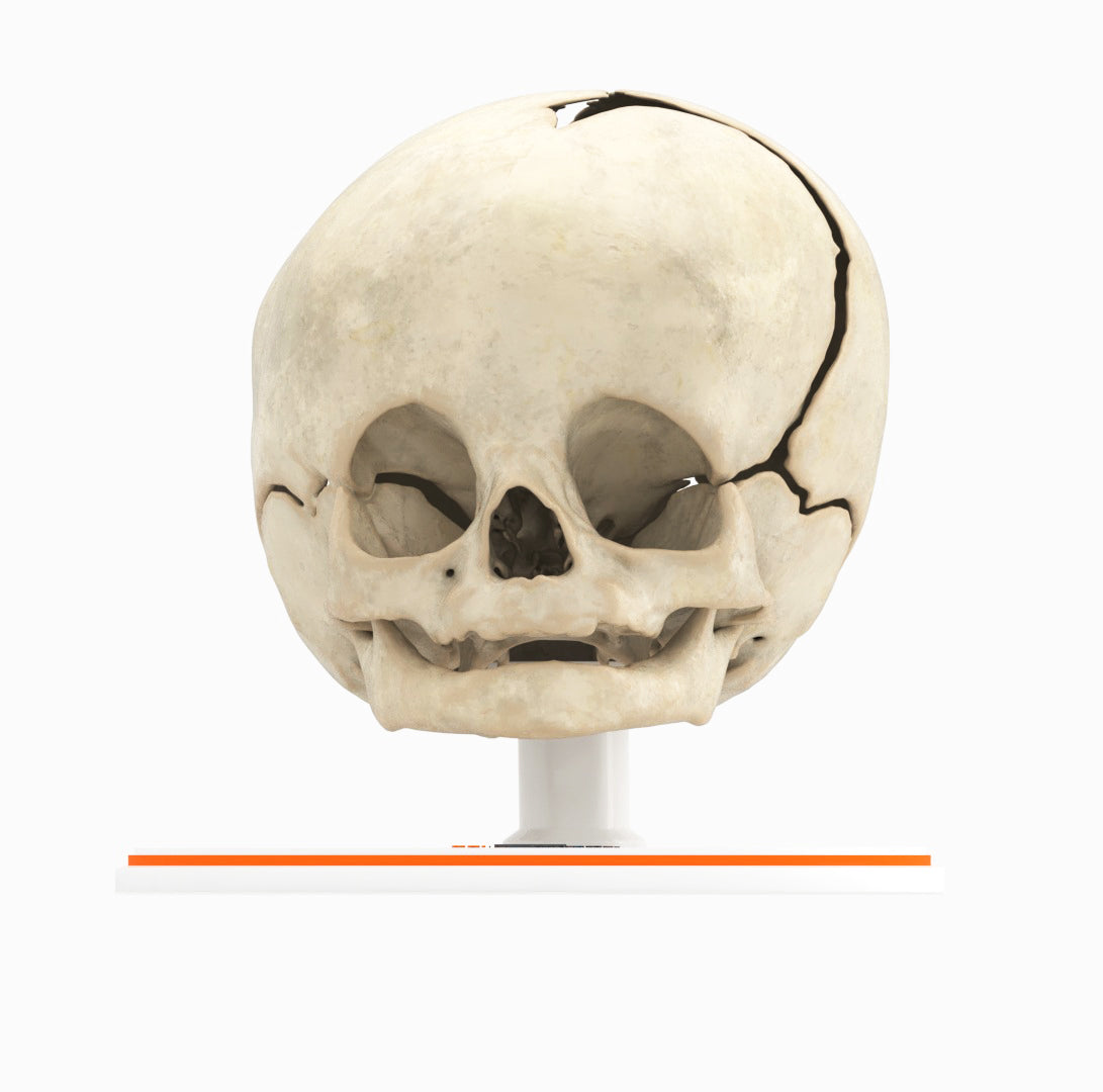 Infant Skull With Unilateral Craniosynostosis of the Coronal Suture - Male, 4 Months