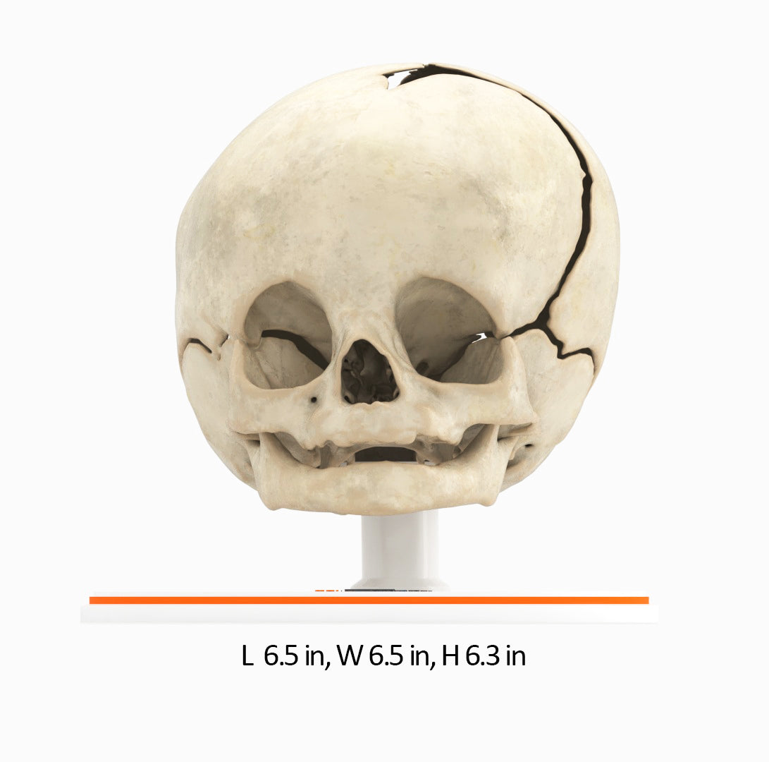 Infant Skull With Unilateral Craniosynostosis of the Coronal Suture - Male, 4 Months