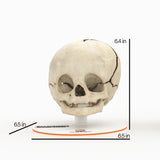 Infant Skull With Unilateral Craniosynostosis of the Coronal Suture - Male, 4 Months