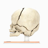 Infant Skull With Unilateral Craniosynostosis of the Coronal Suture - Male, 4 Months