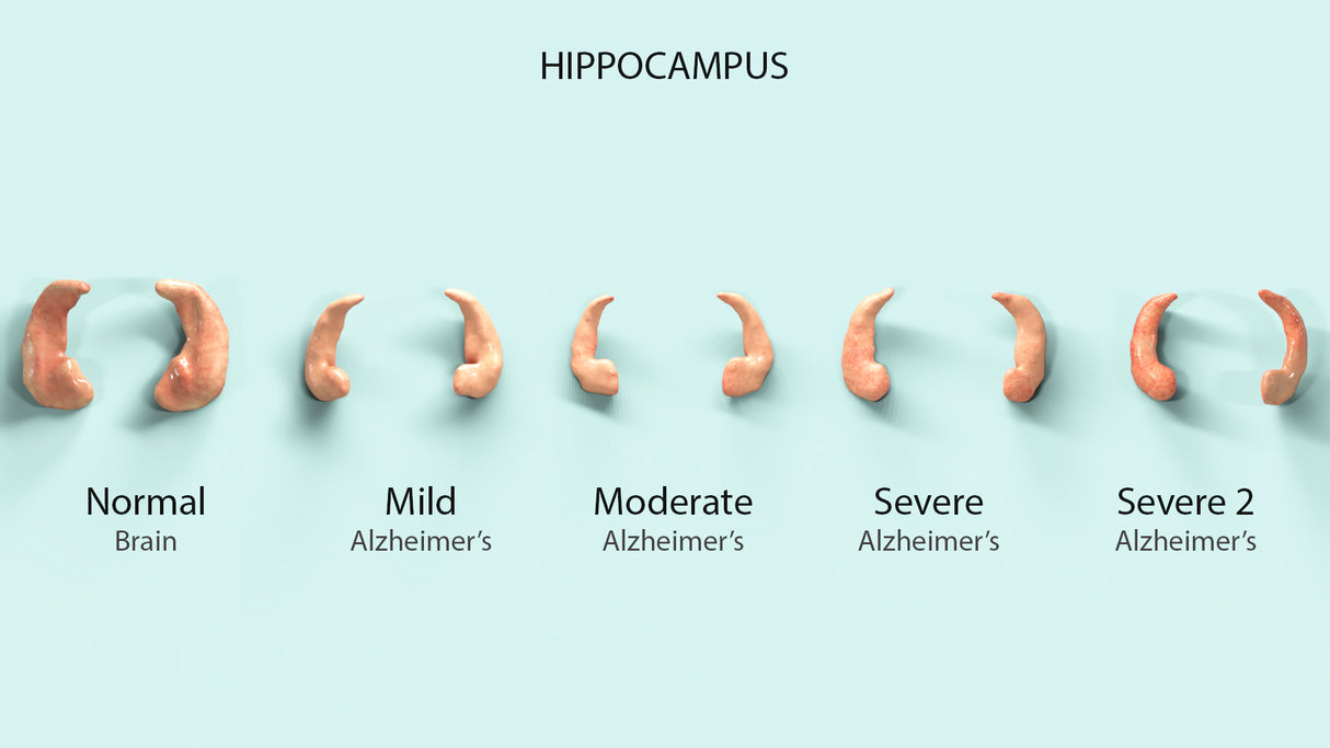 Adult Brain With Alzheimer’s Disease, Mild