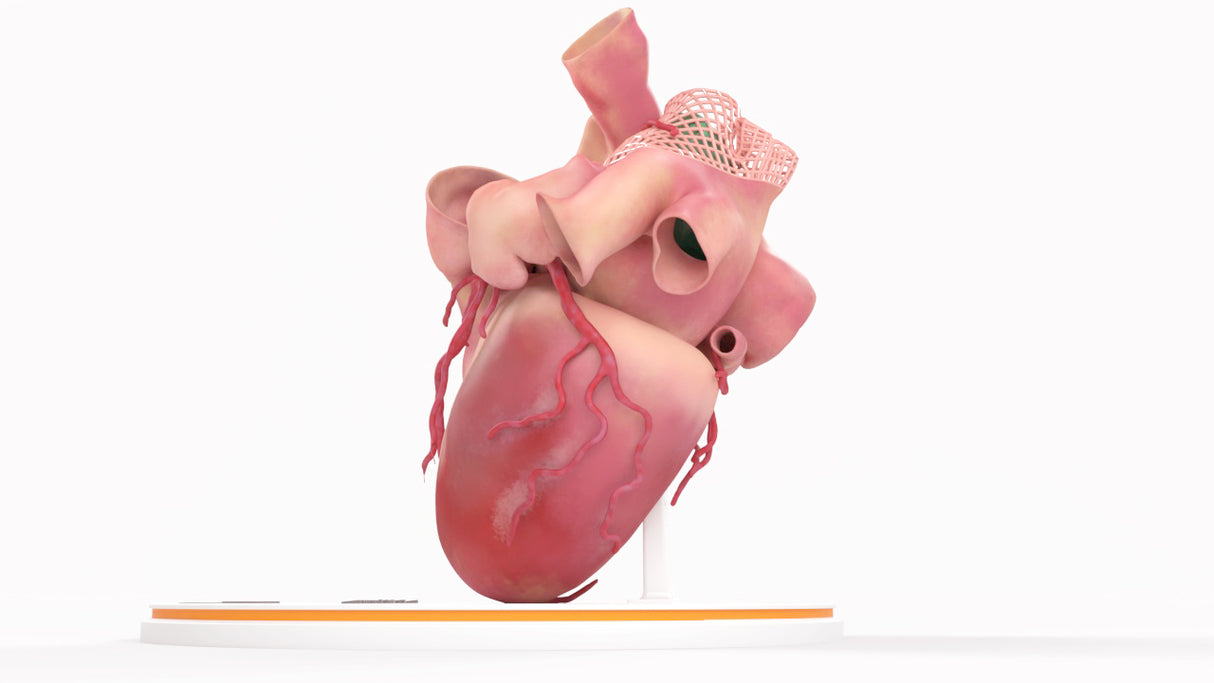 Left Atrium Myxoma, Closed - Female, 73 Years