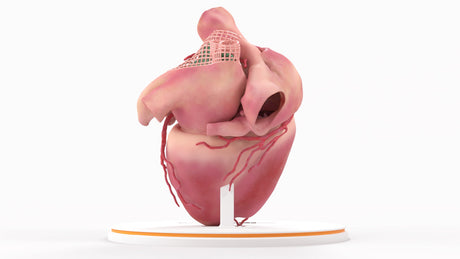 Left Atrium Myxoma, Closed - Female, 73 Years