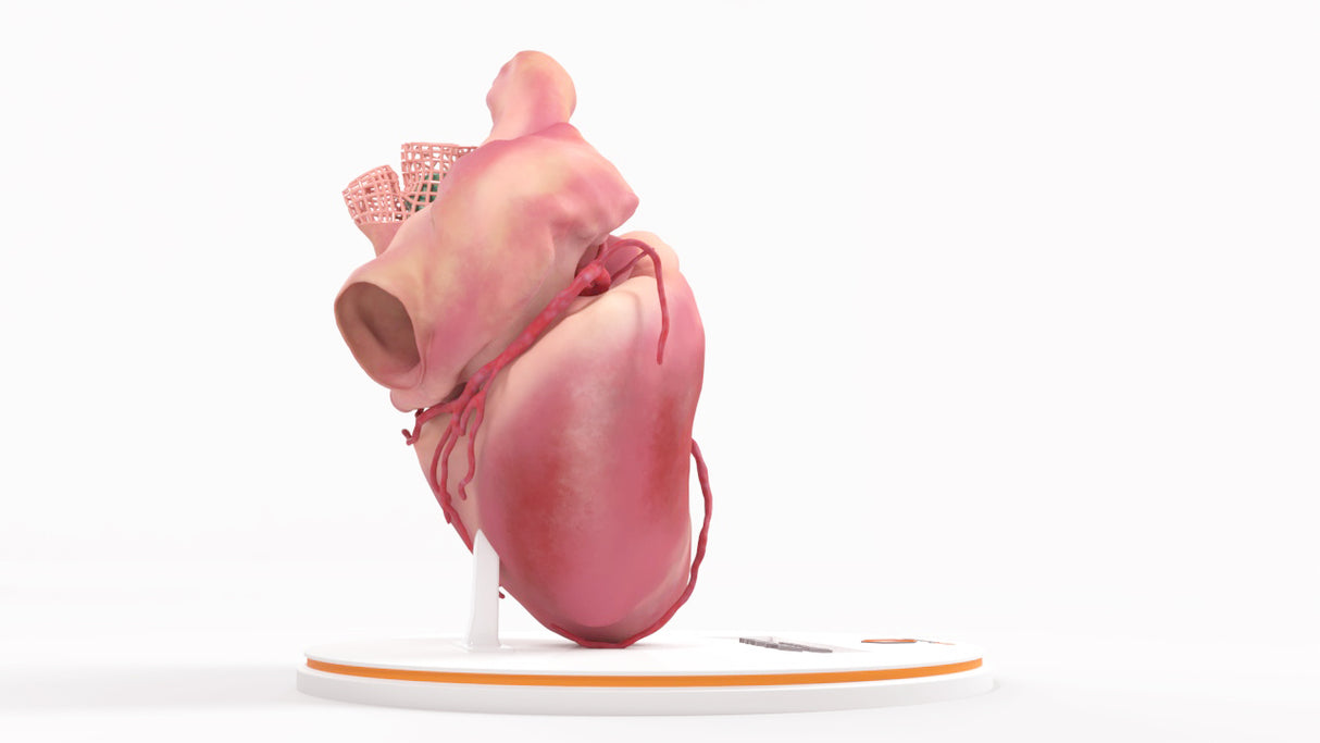 Left Atrium Myxoma, Closed - Female, 73 Years