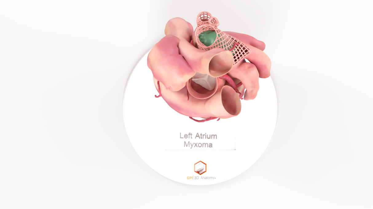 Left Atrium Myxoma, Closed - Female, 73 Years