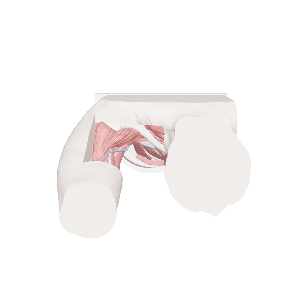 Thoracic Outlet Syndrome (TOS), Arm Up