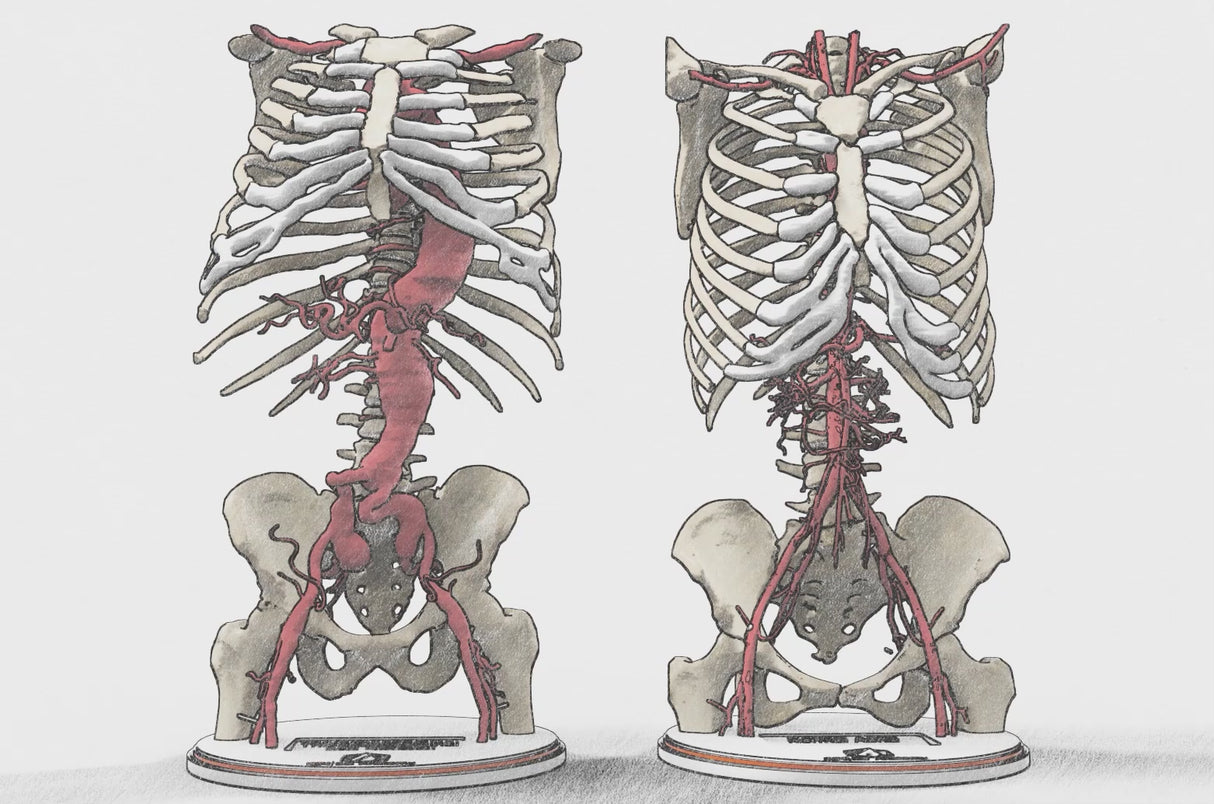 Aortic Arch Aneurysm (Ascending Aorta)