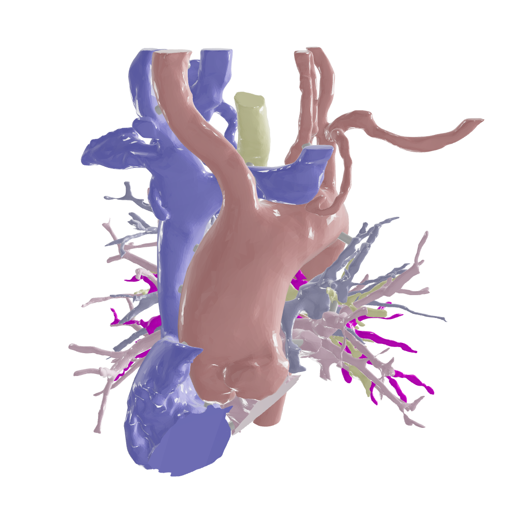 Pulmonary Atresia (Patent Ductus Arteriosus) - Female, 9 Years