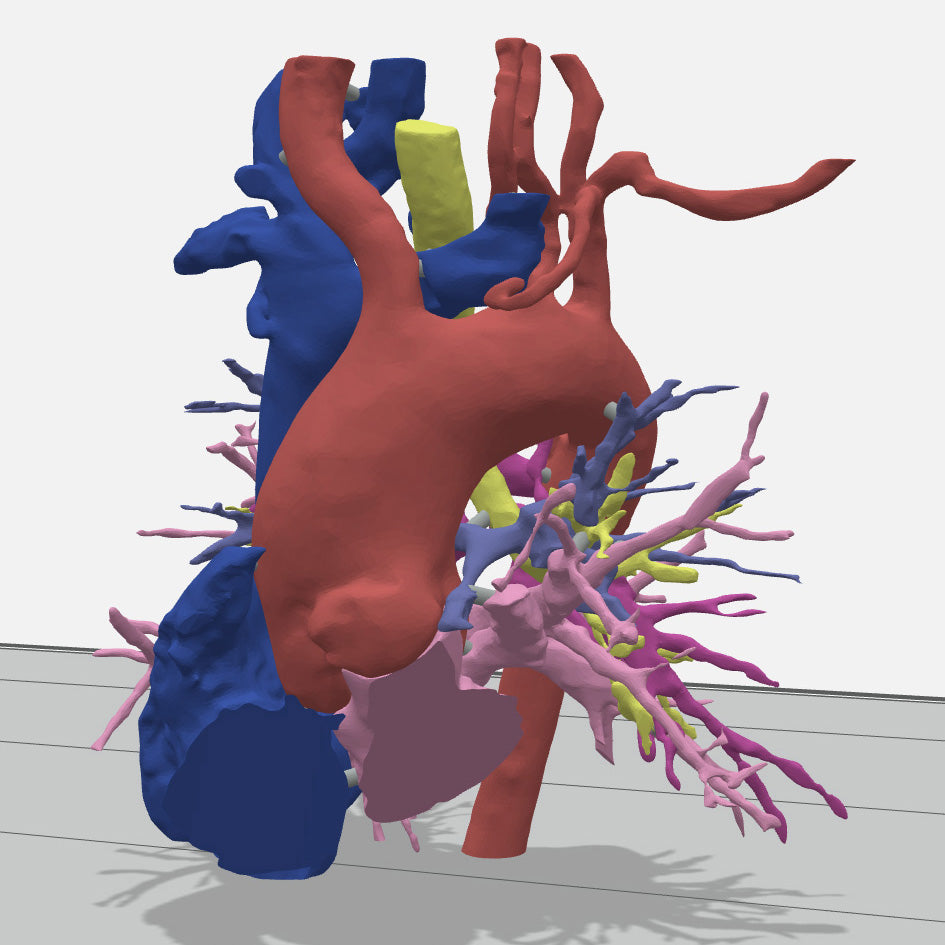 Pulmonary Atresia (Patent Ductus Arteriosus) - Female, 9 Years