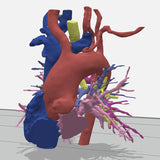 Pulmonary Atresia (Patent Ductus Arteriosus) - Female, 9 Years