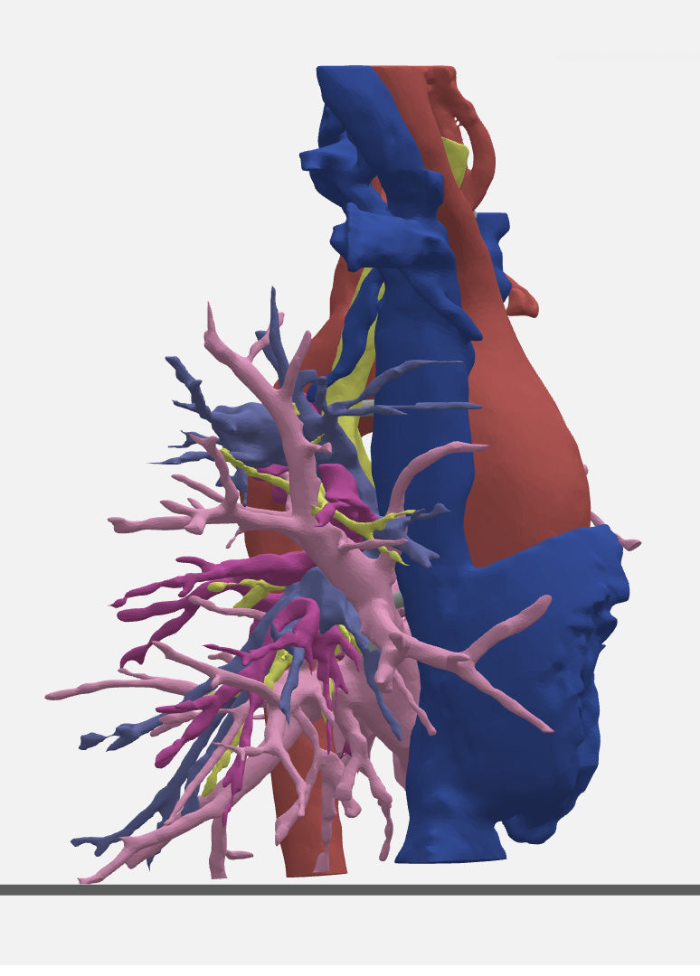 Pulmonary Atresia (Patent Ductus Arteriosus) - Female, 9 Years