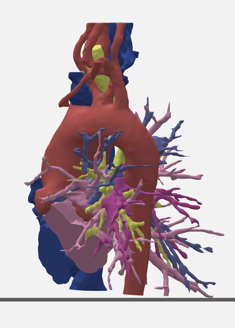 Pulmonary Atresia (Patent Ductus Arteriosus) - Female, 9 Years