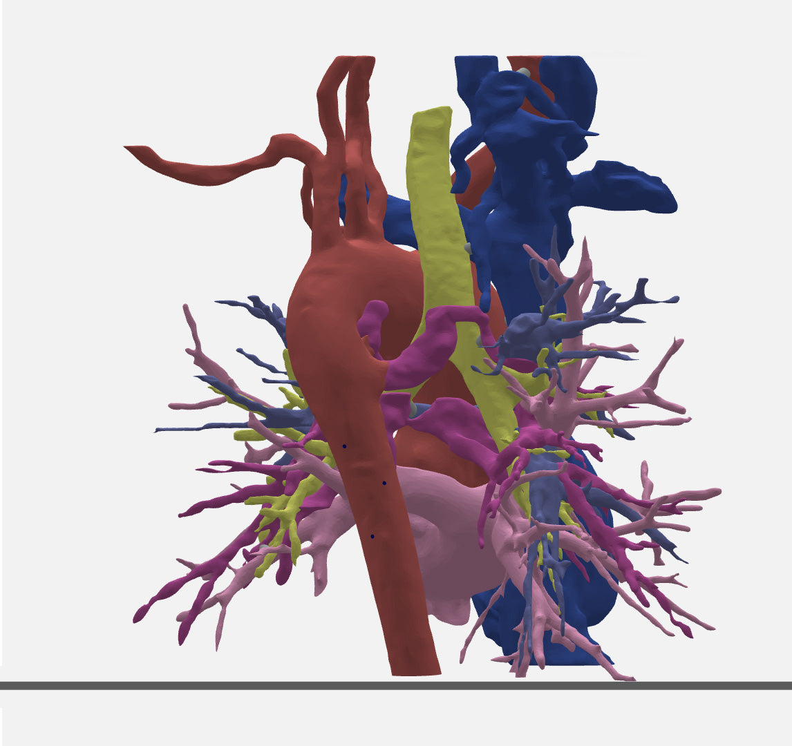 Pulmonary Atresia (Patent Ductus Arteriosus) - Female, 9 Years