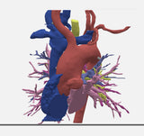 Pulmonary Atresia (Patent Ductus Arteriosus) - Female, 9 Years