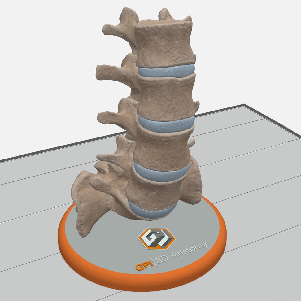 Spine With Spondylolisthesis (Anterolisthesis), Grade 3 – Female, 17 Years