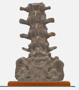 Spine With Spondylolisthesis (Anterolisthesis), Grade 3 – Female, 17 Years