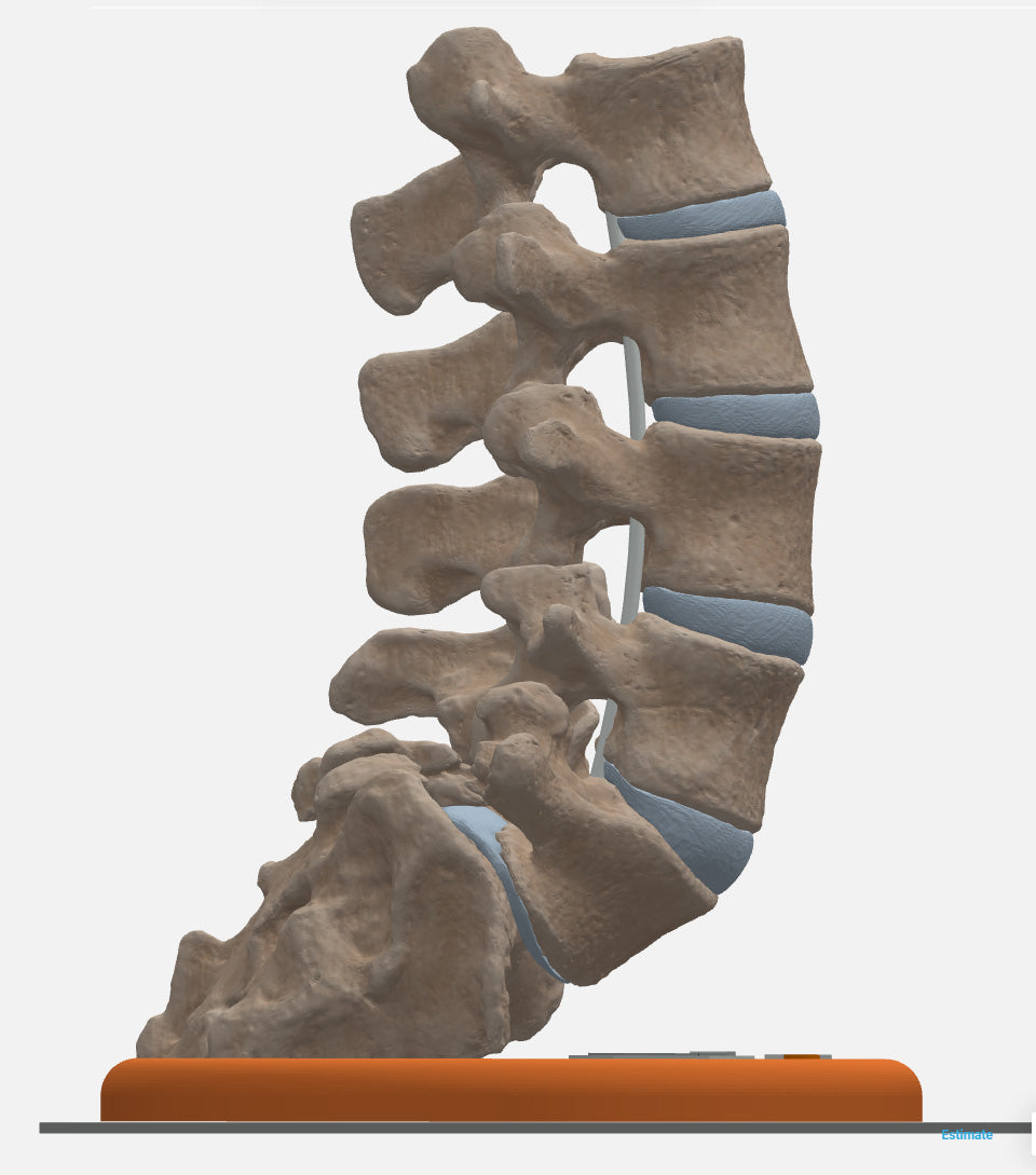 Spine With Spondylolisthesis (Anterolisthesis), Grade 3 – Female, 17 Years