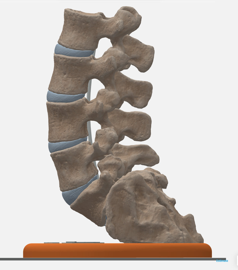 Spine With Spondylolisthesis (Anterolisthesis), Grade 3 – Female, 17 Years