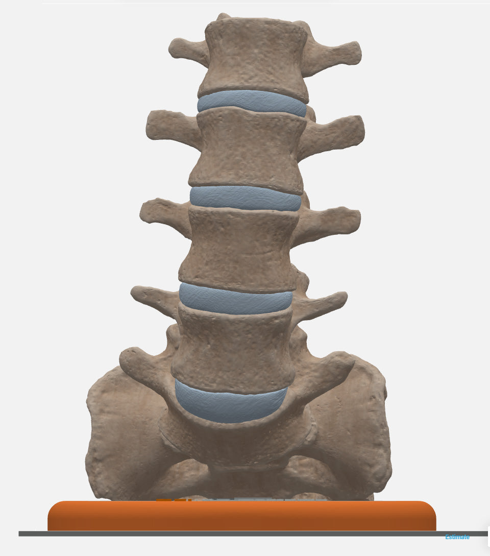 Spine With Spondylolisthesis (Anterolisthesis), Grade 3 – Female, 17 Years