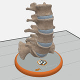 Spine With Spondylolysis (Pars Defect), Grade 4 – Female, 16 Years