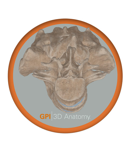 Spine With Spondylolysis (Pars Defect), Grade 4 – Female, 16 Years