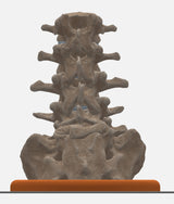 Spine With Spondylolysis (Pars Defect), Grade 4 – Female, 16 Years