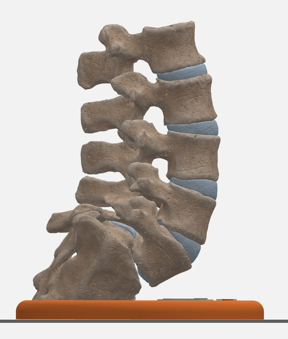 Spine With Spondylolysis (Pars Defect), Grade 4 – Female, 16 Years