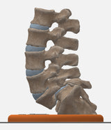 Spine With Spondylolysis (Pars Defect), Grade 4 – Female, 16 Years