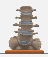 Spine With Spondylolysis (Pars Defect), Grade 4 – Female, 16 Years