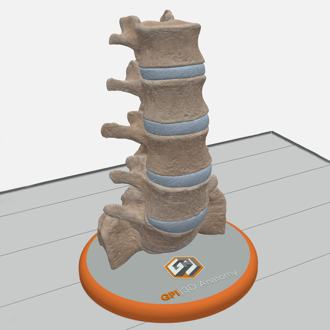 Spine With Bilateral Spondylolysis (Pars Defect), Grade 1 – Male, 27 years