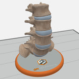 Spine With Spondylolisthesis (Anterolisthesis), Grade 5