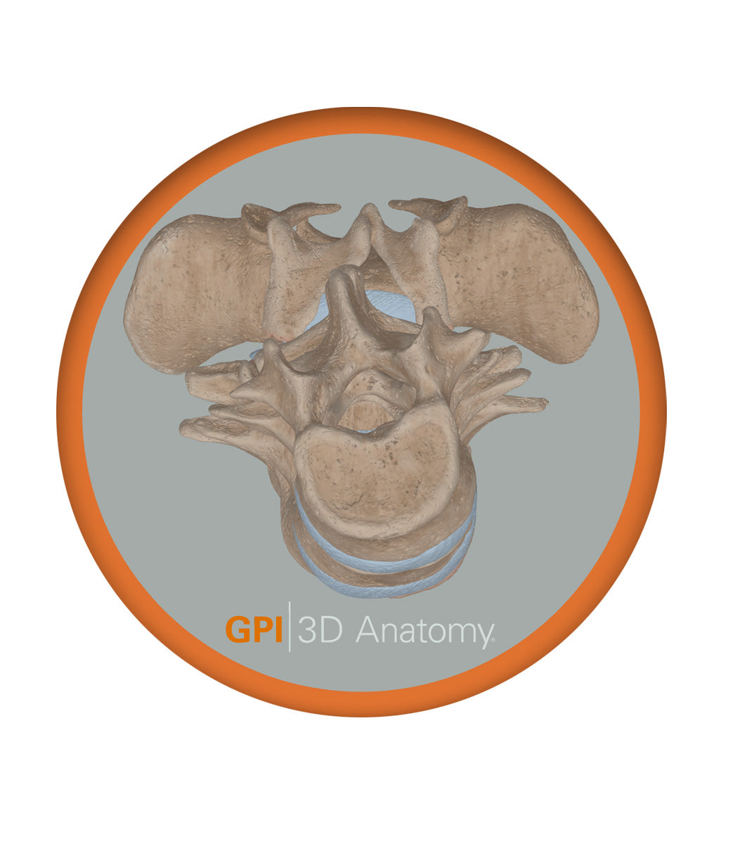 Spine With Spondylolisthesis (Anterolisthesis), Grade 5