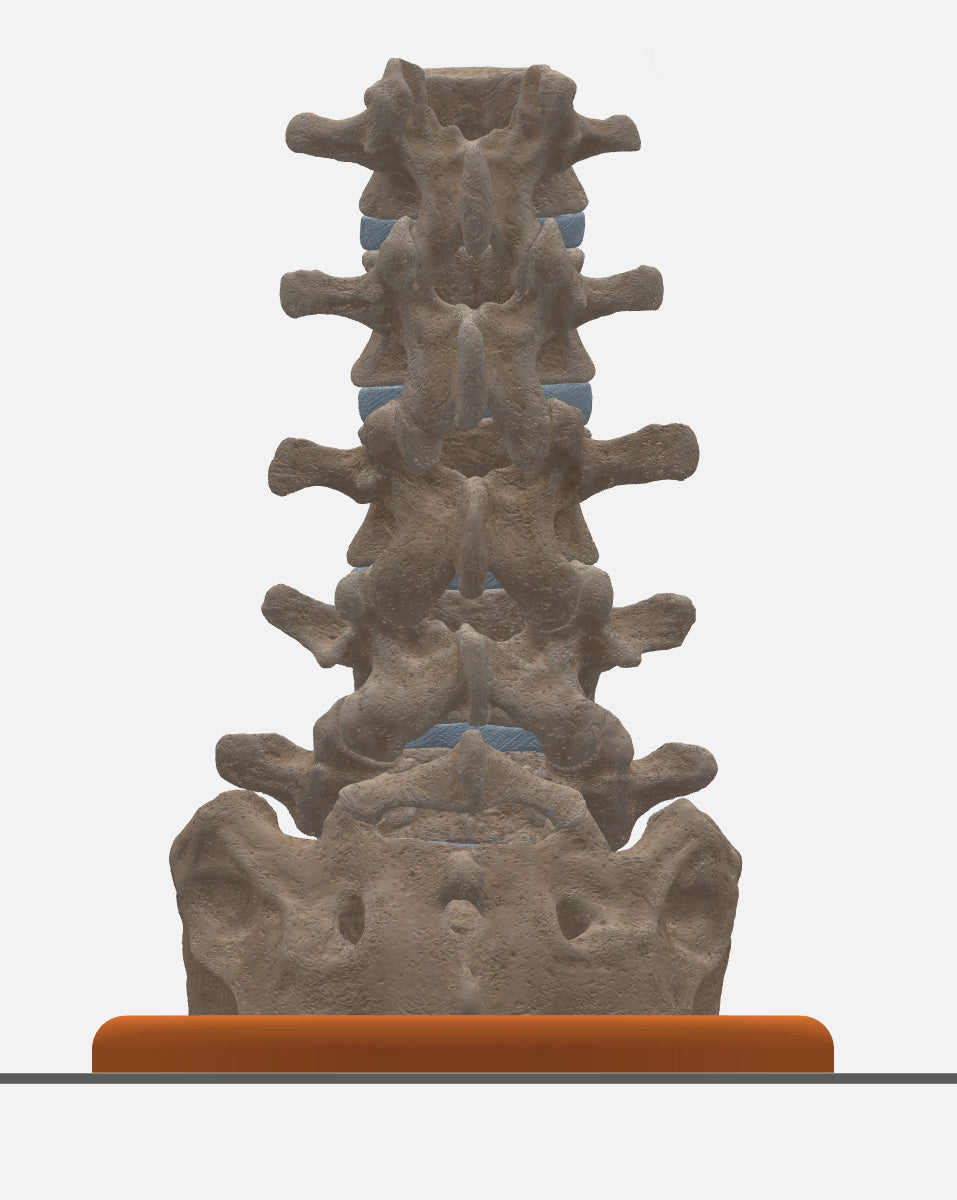 Spine With Bilateral Spondylolysis (Pars Defect), Grade 1 – Male, 27 years