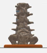 Spine With Spondylolisthesis (Anterolisthesis), Grade 5