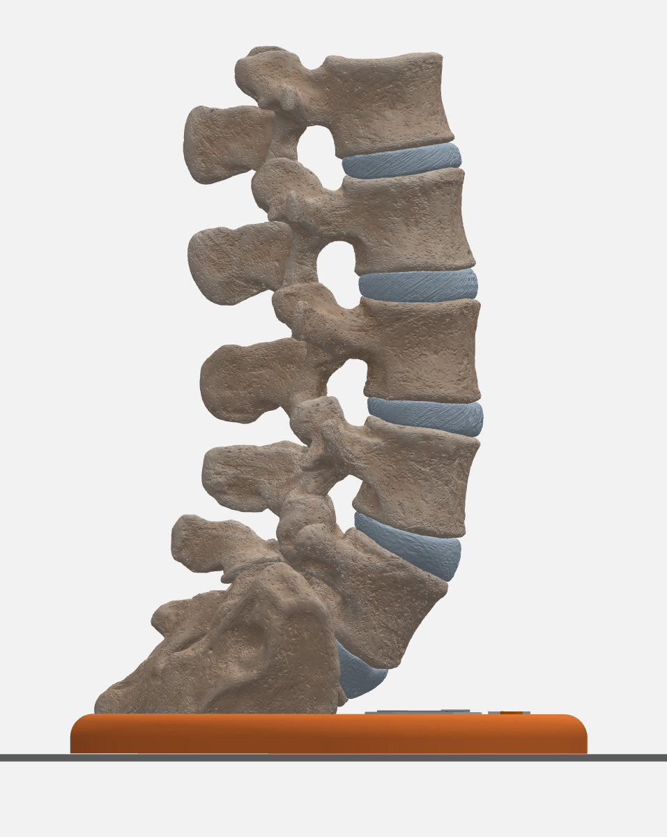 Spine With Bilateral Spondylolysis (Pars Defect), Grade 1 – Male, 27 years