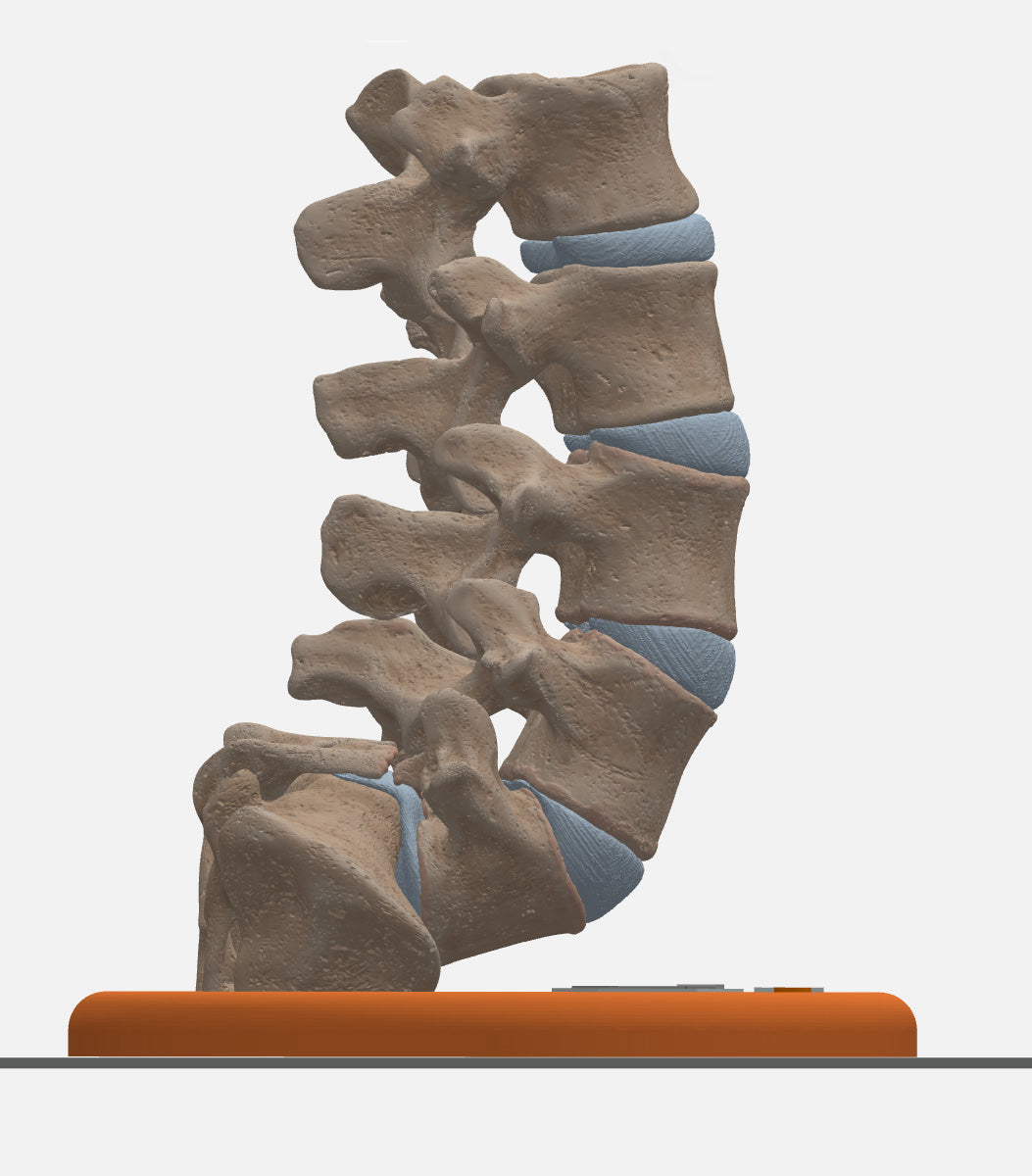 Spine With Spondylolisthesis (Anterolisthesis), Grade 5