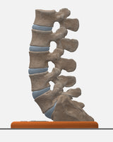 Spine With Bilateral Spondylolysis (Pars Defect), Grade 1 – Male, 27 years