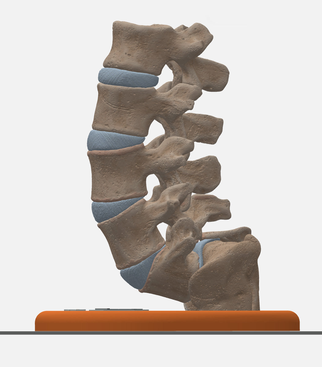 Spine With Spondylolisthesis (Anterolisthesis), Grade 5