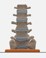 Spine With Bilateral Spondylolysis (Pars Defect), Grade 1 – Male, 27 years