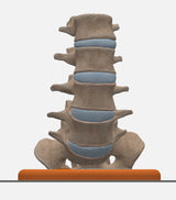 Spine With Spondylolisthesis (Anterolisthesis), Grade 5