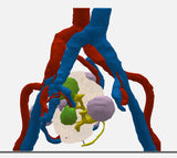 Clear Left Kidney With Neoplasm and Cysts – Male, 78 Years