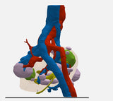 Clear Left Kidney With Neoplasm and Cysts – Male, 78 Years